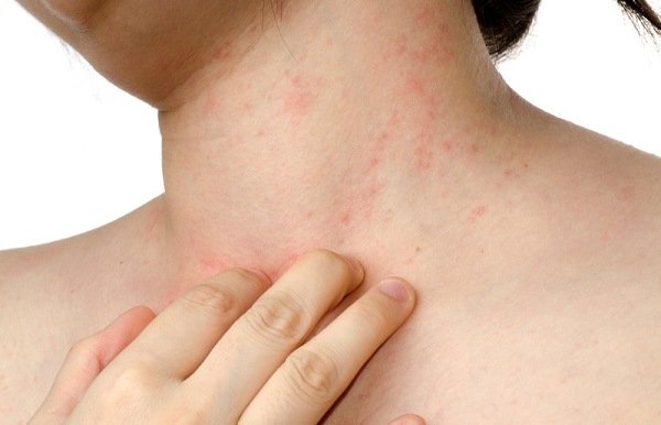 Аллергическая реакция кожи на пылевого клеща