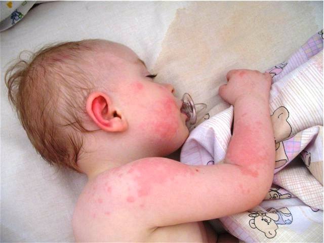 Аллергическая реакция у ребенка на постельного клеща