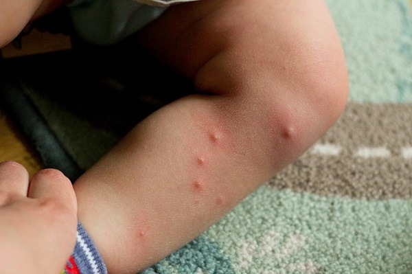 Следы укусов клопов на ножке ребенка