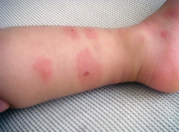 Аллергическая реакция у ребенка на укусы клопов