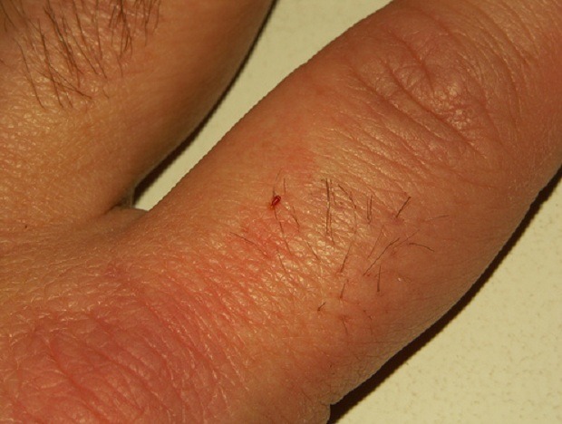 Личинка клопа на пальце человека