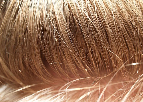 Гниды в волосах у ребенка