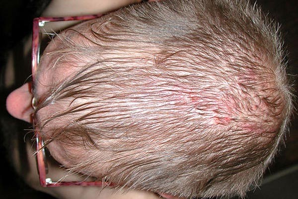 Дерматит волосистой части головы